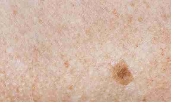 arly detection is crucial for successful melanoma treatment. arly detection is crucial for successful melanoma treatment.