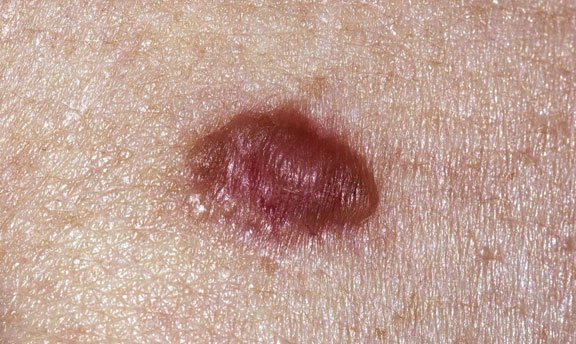 Basal Cell Carcinoma Basal Cell Carcinoma