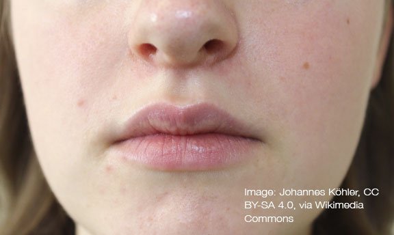 Perioral Dermatitis: The Rash Around Your Mouth That Won’t Quit Perioral Dermatitis: The Rash Around Your Mouth That Won't Quit