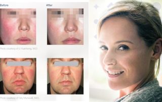Before and after pictures of rosacea